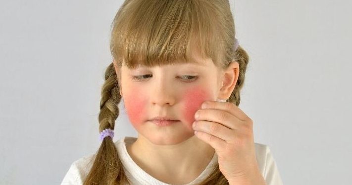 Besin alerjisi farkındalık haftası başladı