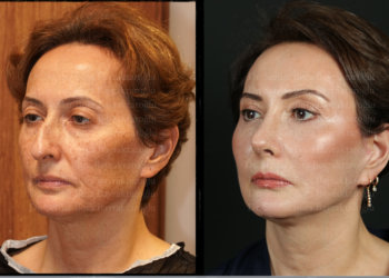 Her Yaşta Yüz Germe Operasyonu Yaptırılabilir mi?