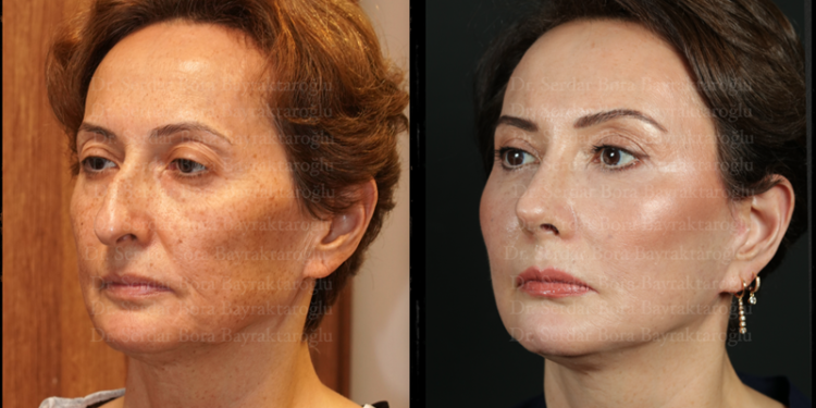 Her Yaşta Yüz Germe Operasyonu Yaptırılabilir mi?