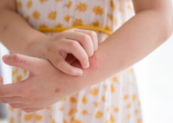 Sivrisinek ısırmasından sonra yüksek eteş ve eklemlerde ağrı varsa mutlaka doktorunuza danışın