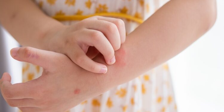 Sivrisinek ısırmasından sonra yüksek eteş ve eklemlerde ağrı varsa mutlaka doktorunuza danışın