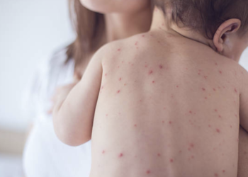 “1 yaş altı bebekler ağır kızamık için risk altında!”