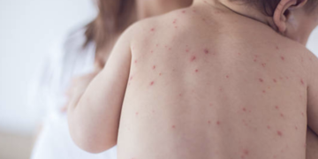 “1 yaş altı bebekler ağır kızamık için risk altında!”