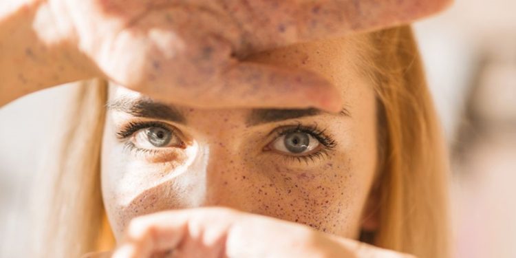 C Vitamini Serumu Güneş Lekelerini Azaltır mı?