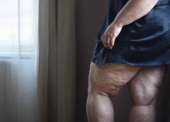 Kadınların Gizli Düşmanı: Lipödem!