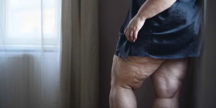Kadınların Gizli Düşmanı: Lipödem!