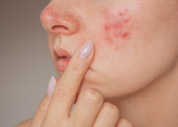 Dr. Özlem Vayvada: Yüzde aniden beliren kabarıklık ürtiker ve anjioödem habercisi olabilir!