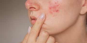 Dr. Özlem Vayvada: Yüzde aniden beliren kabarıklık ürtiker ve anjioödem habercisi olabilir!