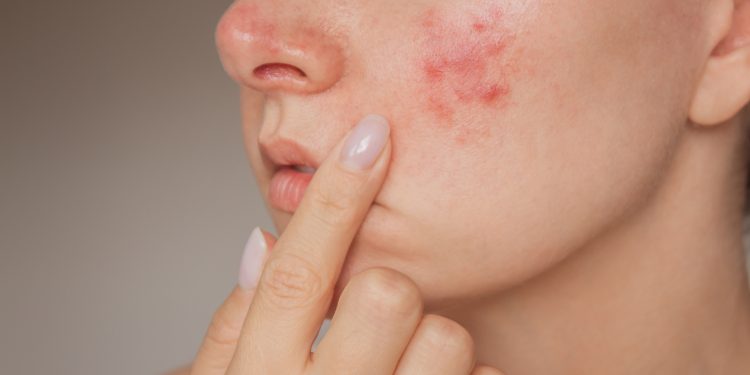 Dr. Özlem Vayvada: Yüzde aniden beliren kabarıklık ürtiker ve anjioödem habercisi olabilir!