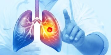 Prof. Dr. Fidan Yıldız Ünal: Her yıl 25 bin akciğer kanseri vakası önlenebilir