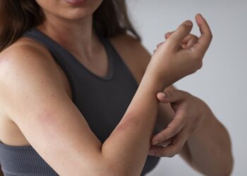 Alerji mi, histamin dengesizliği mi? Benzer belirtiler yanıltıcı olabilir